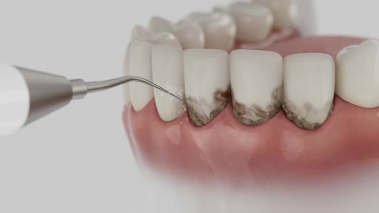 Reliable Tooth Extraction contractor in Lawrence, MA by Smile Center Dentistry